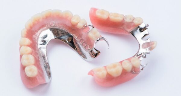 RPD (Removable Partial Denture) – Suraksha Dental